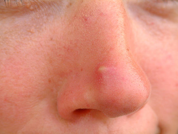 Big Pimple So, what are you people using this image for?  I'd love to know! human nose stock pictures, royalty-free photos & images