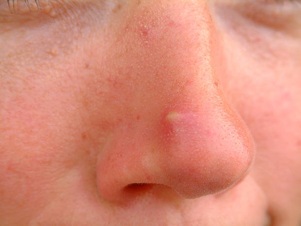 Big Pimple So, what are you people using this image for? I'd love to know! nose flower stock pictures, royalty-free photos & images