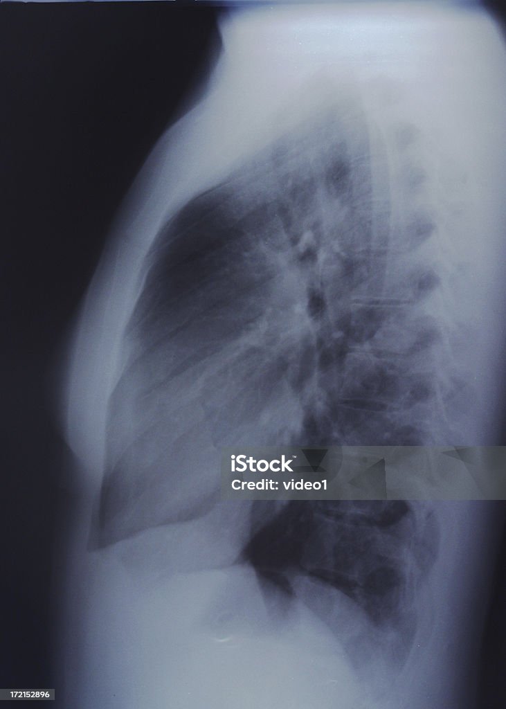 Lung x-ray - Photo de Asthmatique libre de droits