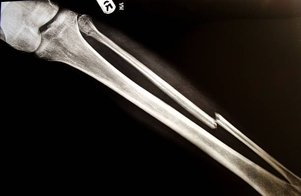 bein pause x-ray - bone fractures stock-fotos und bilder