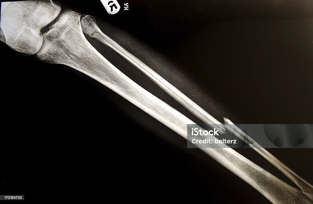leg break x-ray an exray showing a badly fractured leg Bone Fracture Stock Photo