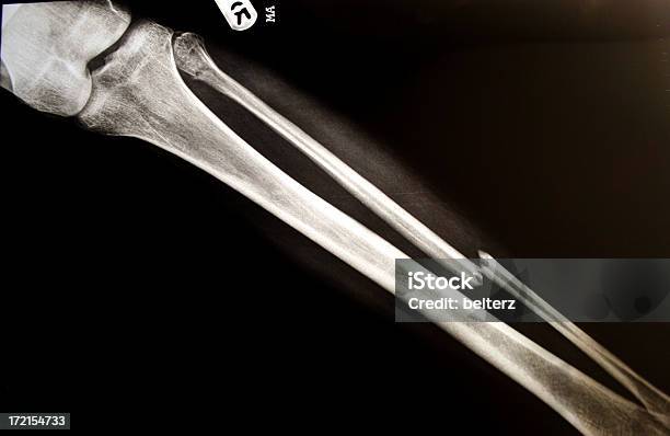 Leg Break Xray Stock Photo - Download Image Now - Bone Fracture, X-ray Image, Broken