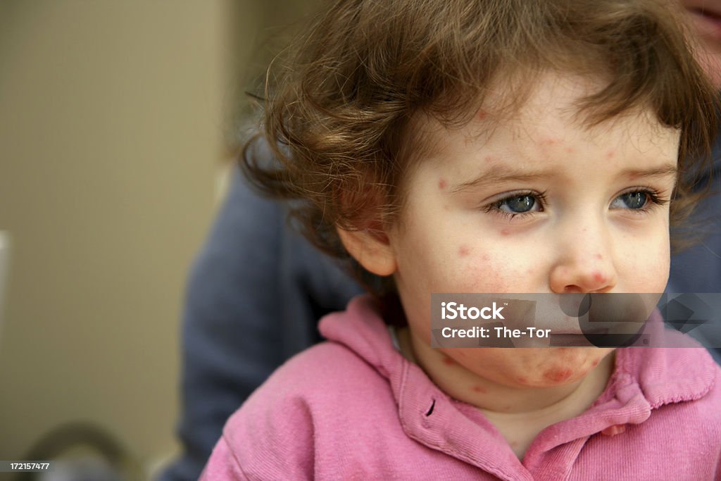 Sick child with red breakout all over his face A girl with chickenpox. Baby - Human Age Stock Photo