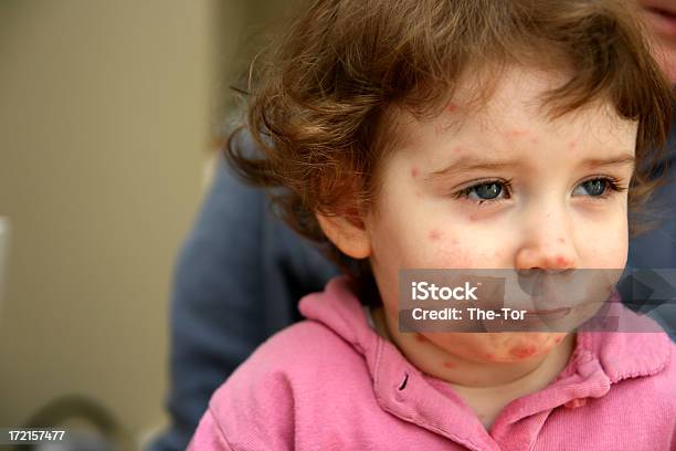 Sick Child With Red Breakout All Over His Face Stock Photo - Download Image Now - Baby - Human Age, Human Face, Chickenpox