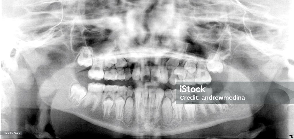 Xray des Kindes Jaw zeigen die Entwicklung putzen - Lizenzfrei Kind Stock-Foto