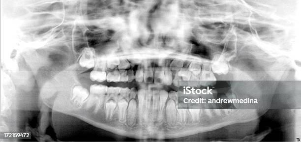 Xray Des Kindes Jaw Zeigen Die Entwicklung Putzen Stockfoto und mehr Bilder von Kind - Kind, Menschlicher Kieferknochen, Röntgenbild