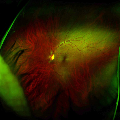 Photographic scan of a human retina. In the middle is the optic nerve, with blood vessels coming out.