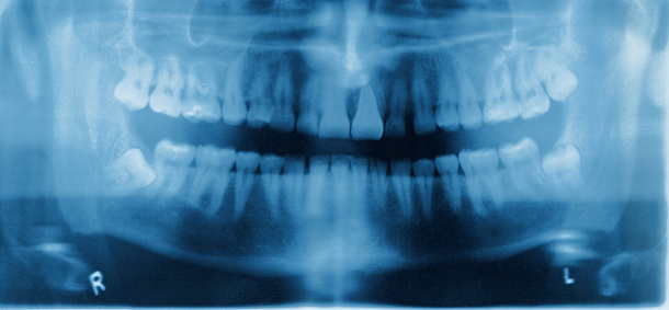 A panoramic circumfrential x-ray of a mouth, with intact wisdom teeth, one of which is severely impacted. This type of x-ray is necessary for maxillo-facial surgery, to evaluate the positions of the roots, and the health and thickness of the jaw bones. The horizontal streaks in the image are from the x-ray camera moving around the patient's face during exposure. My 26th flame on August 1, 2007. Thanks!