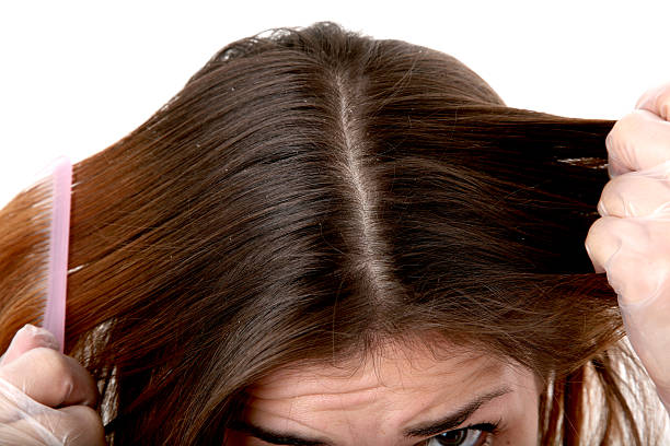 5,534 Dandruff Treatment Stock Photos, Pictures & Royalty-Free Images - iStock | Dandruff hair, Dandruff women 5,534 Dandruff Treatment Stock Photos, Pictures & Royalty-Free Images - iStock | Dandruff hair, Dandruff women