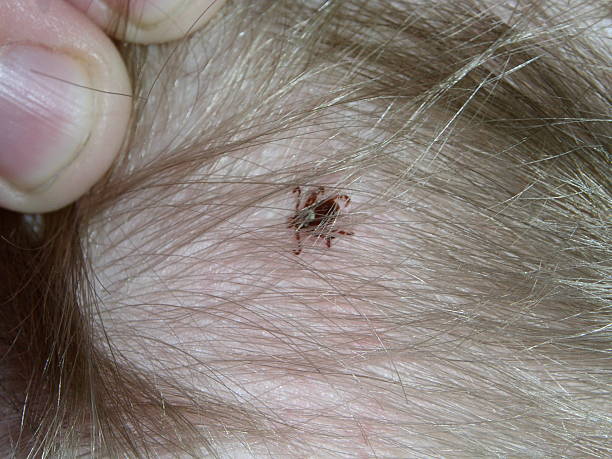 Tick In Hair A small tick is embedded in the scalp of a young boy. deer tick arachnid photos stock pictures, royalty-free photos & images