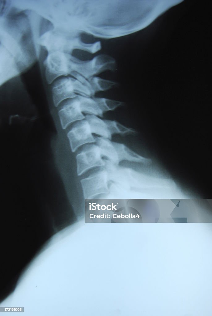 Lado de un cuello de rayos X - Foto de stock de Ajuste quiropráctico libre de derechos
