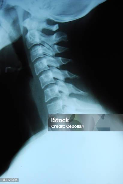 Lado De Un Cuello De Rayos X Foto de stock y más banco de imágenes de Ajuste quiropráctico - Ajuste quiropráctico, Anatomía, Articulación humana