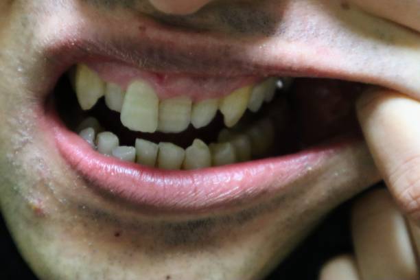 istock Close-up of a person with misaligned teeth 1722122204