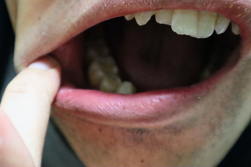 Close-up photo of a person with crooked teeth