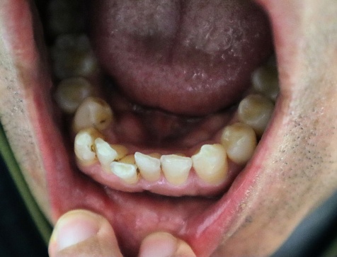 Close-up photo of a person with crooked teeth