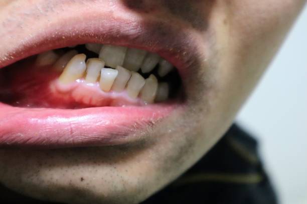 istock Close-up of a person with misaligned teeth 1722123873