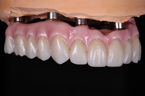 This image shows a close-up of a model of teeth on a black background. The model is made of white plastic, and it has a realistic appearance. The teeth are arranged in a natural way, and they have a variety of shapes and sizes.