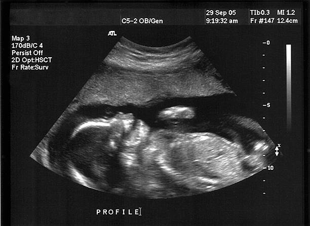 Ultra Sound (Baby with mouth open) stock photo