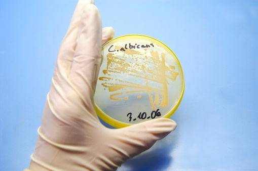 Petri disc with Candida alcicans culture.had of scientist holding to evaluate the growthother topic realted pictures