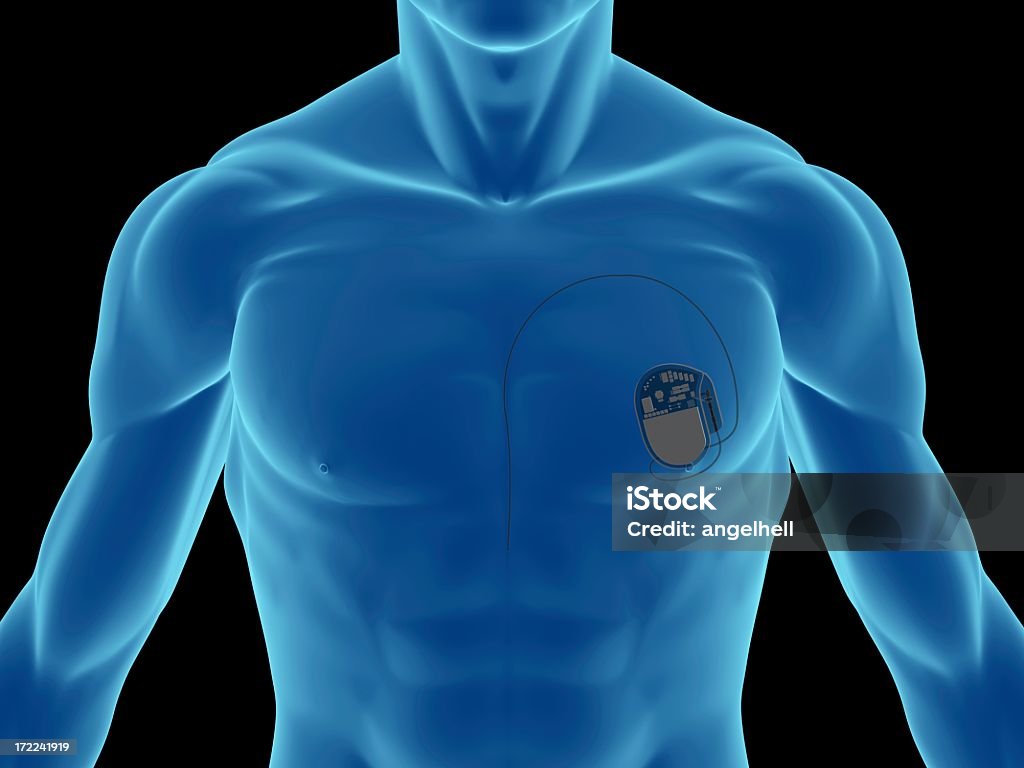 Herzschrittmacher auf der Brust - Lizenzfrei Herzschrittmacher Stock-Foto
