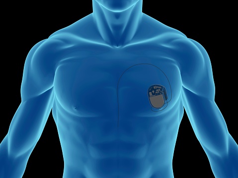 X-ray of a man, showing a pacemaker (for heart) on chest, on front view, great to be used in medicine works and health. Isolated on a black background. 