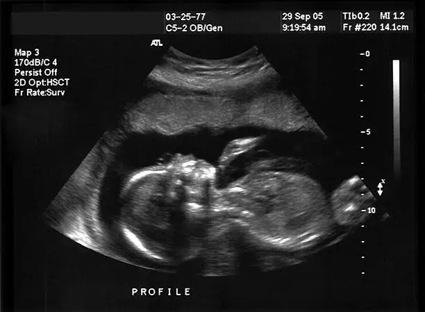 Photo of A ultra sound picture of a baby