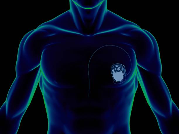 кардиостимулятор на груди - pacemaker torso chest male стоковые фото и изображения