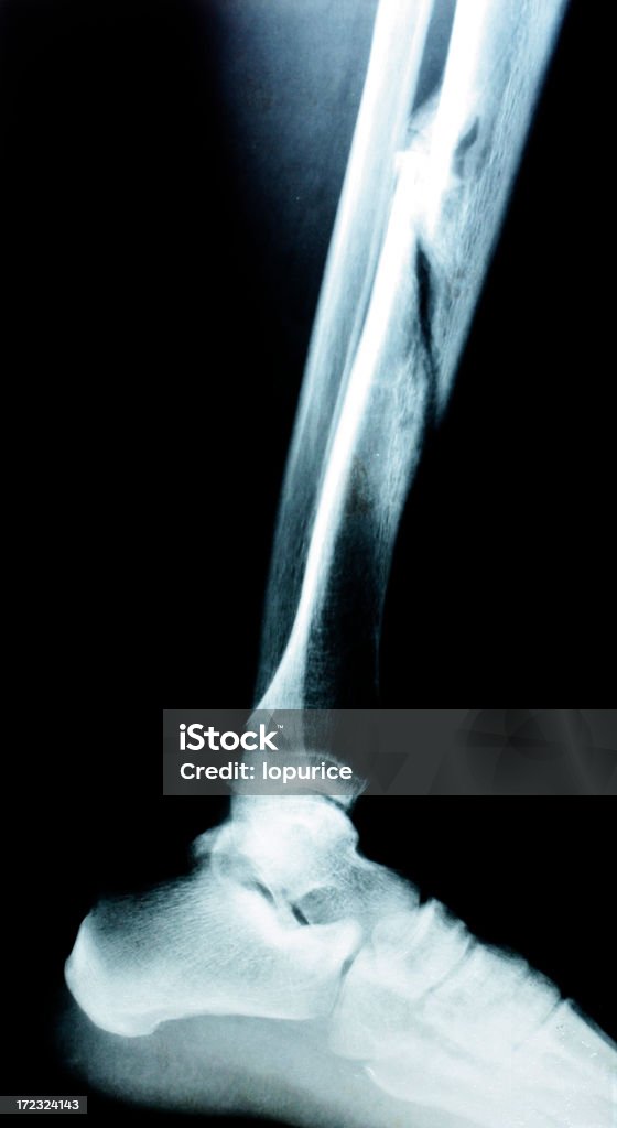 broken a broken leg Bone Fracture Stock Photo