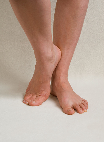 Swelling of the legs, closeup. Swelling females feet standing on a carpet