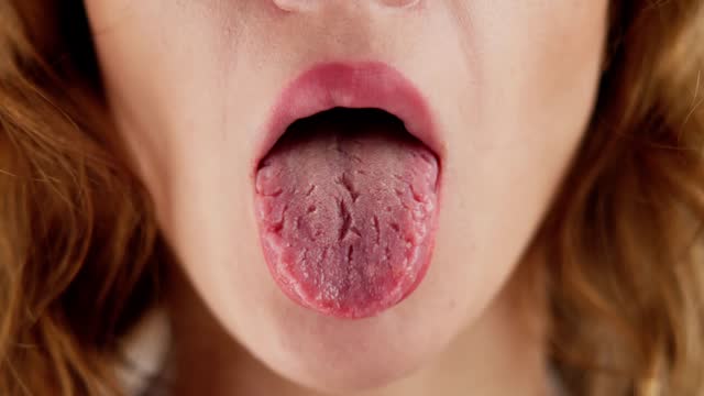 Dry Tongue Pain And Cracks