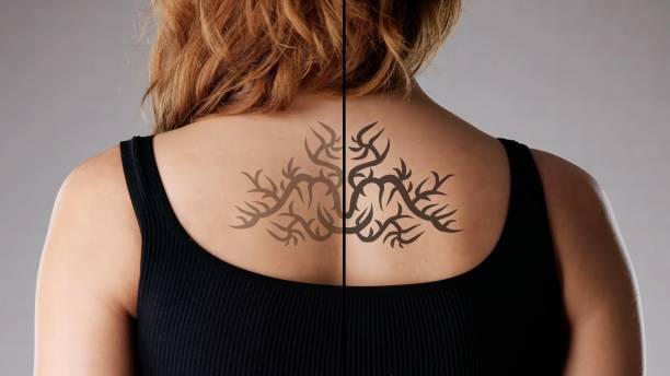 istock Laser Tattoo Removal On Woman's Back 1723588484