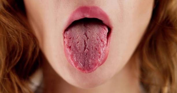 istock Dry Tongue Pain And Cracks 1723589053