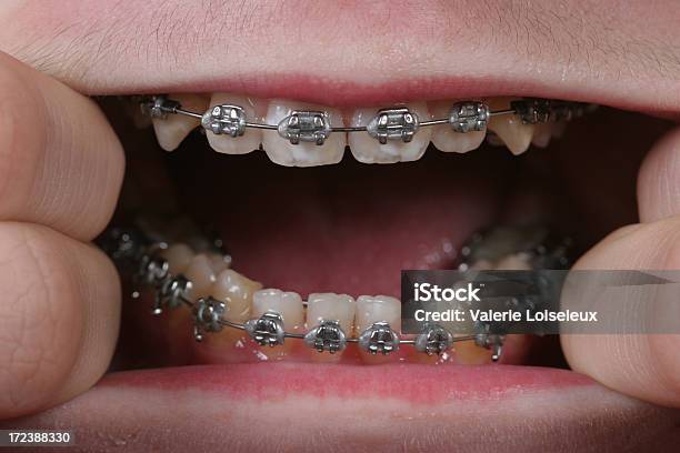 Braces Stock Photo - Download Image Now - Adolescence, Beauty, Dental Braces