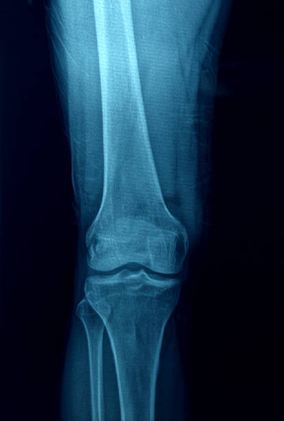 imagerie par rayons x des pieds - bending human foot ankle x ray image photos et images de collection