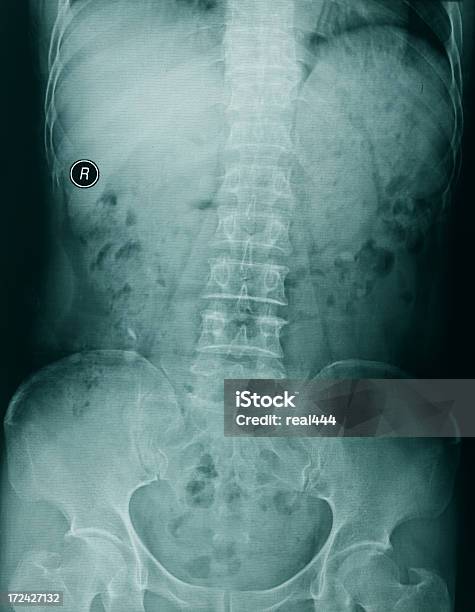 Chest Xray Image Stock Photo - Download Image Now - Anatomy, Bronchial Tree, Chest - Torso
