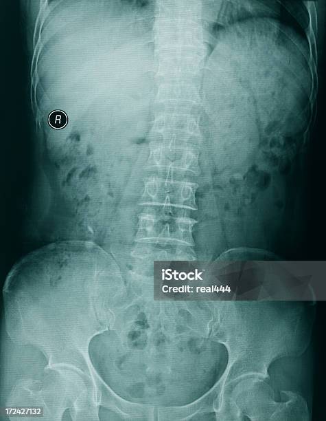 Zdjęcie Rentgenowskie Klatki Piersiowej - zdjęcia stockowe i więcej obrazów Anatomia człowieka - Anatomia człowieka, Badanie lekarskie, Ból