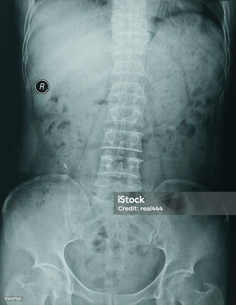 Peito Imagem de raios X - Foto de stock de Anatomia royalty-free