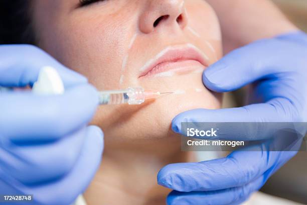 Injectar Hyaluronic Ácido - Fotografias de stock e mais imagens de Queixo - Queixo, Injetar, Cirurgia Plástica