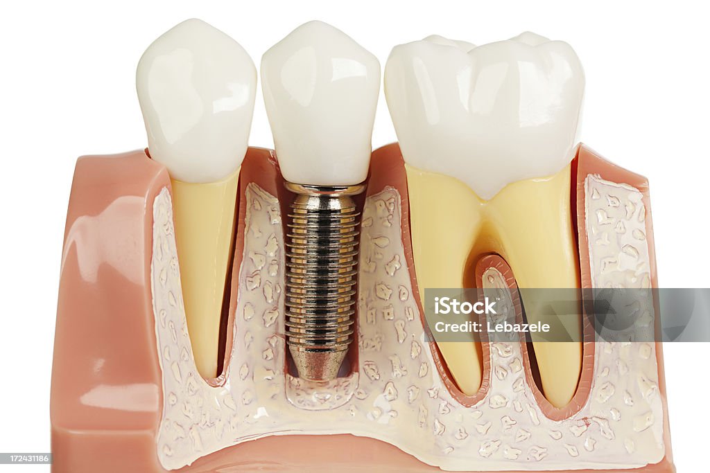 歯のインプラントモデルキャップ - 歯科衛生のロイヤリティフリーストックフォト