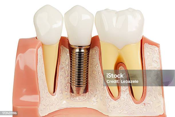 歯のインプラントモデルキャップ - 歯科衛生のストックフォトや画像を多数ご用意 - 歯科衛生, 人工装具, 3D