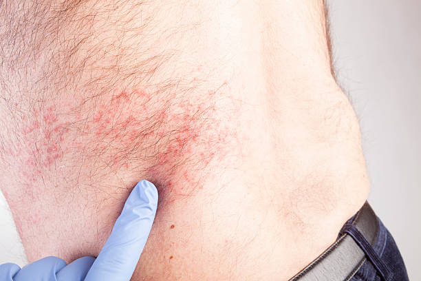 Eczema atopic dermatitis symptom skin texture. stock photo