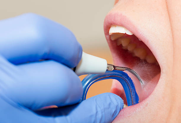 istock Cleaning dental calculus 172434937