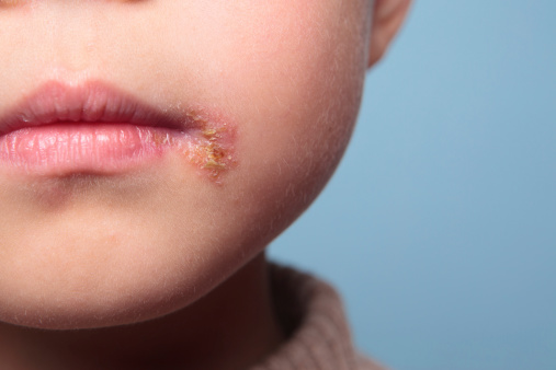 Closeup of a common cold sore virus herpes simplex.