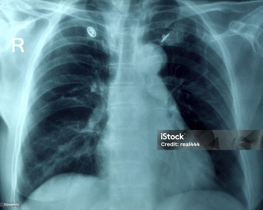 흉부 X-선 이미지 - 로열티 프리 X-레이 스톡 사진