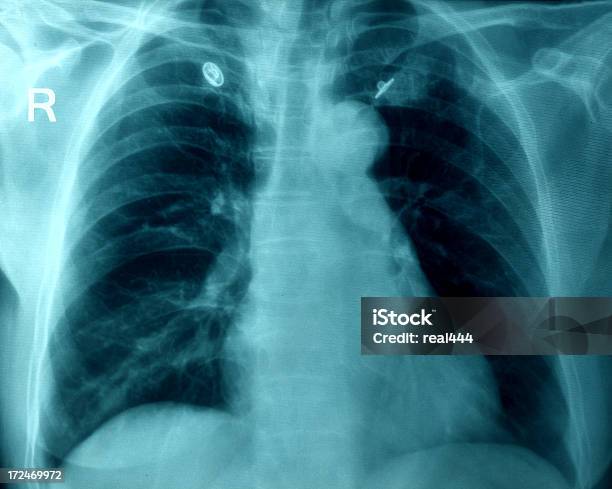 흉부 X선 이미지 X-레이에 대한 스톡 사진 및 기타 이미지 - X-레이, 갈비사이공간, 건강 진단