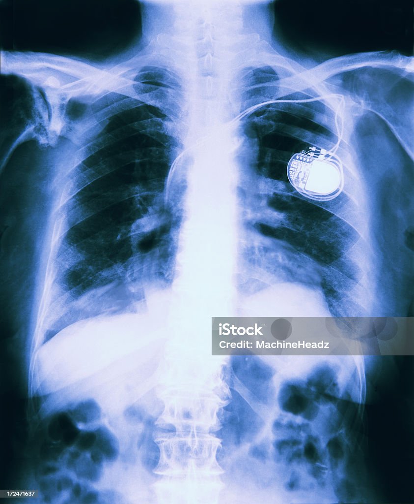 X-Ray do peito com um marcapasso justa - Foto de stock de Marcapasso - Equipamento técnico médico royalty-free