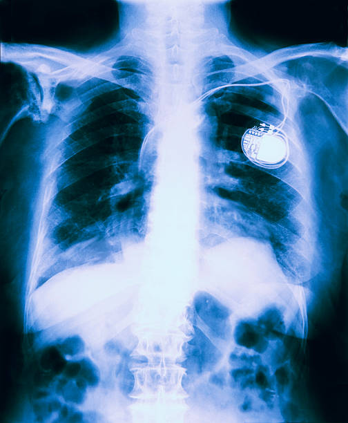 рентгенография грудной клетки, свидетельствующие о кардиостимулятор облегающий - pacemaker torso chest male стоковые фото и изображения