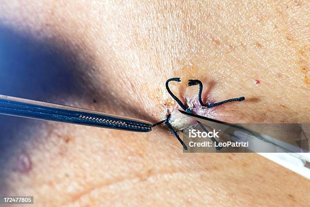 Closeup Entfernen Sie Die Naht Von Den Patienten Zurück Stockfoto und mehr Bilder von Arzt