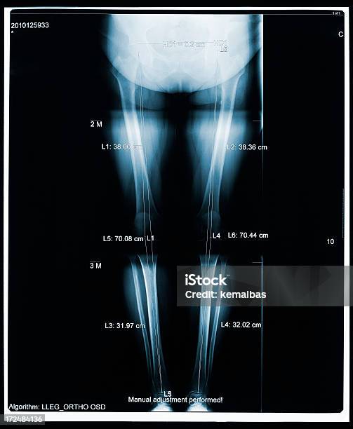 Photo libre de droit de Xray Des Jambes banque d'images et plus d'images libres de droit de Anatomie - Anatomie, Articulation du corps humain, Articulations