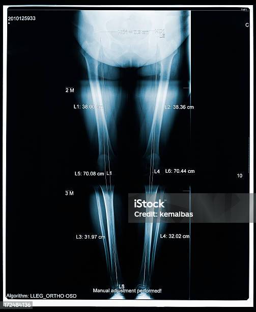 Xray Z Nogi - zdjęcia stockowe i więcej obrazów Anatomia człowieka - Anatomia człowieka, Badanie lekarskie, Ciało ludzkie